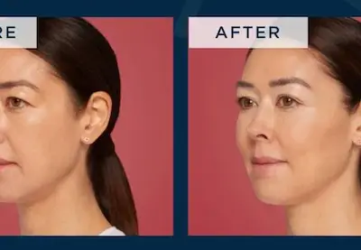 Restylane Eyelight