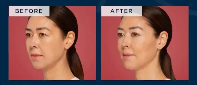 Restylane Eyelight