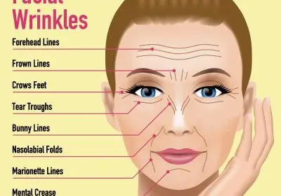 What areas of the face can be treated with Dysport