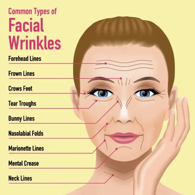 What areas of the face can be treated with Dysport