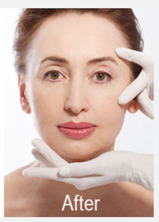 restylane defyne