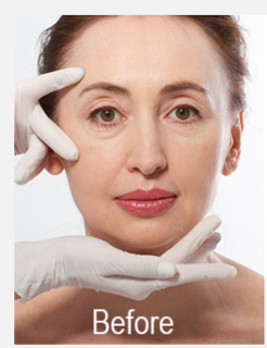restylane lip injections